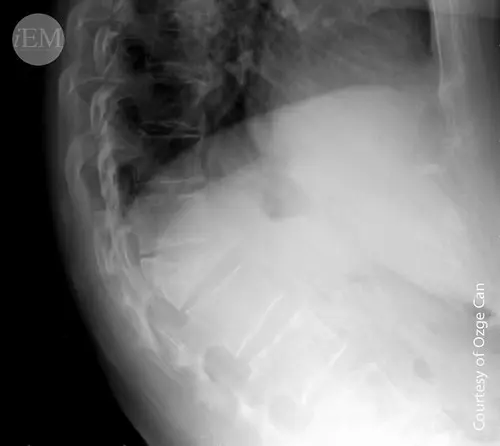 815 - L1 burst fracture on lateral lomber vertebrae view